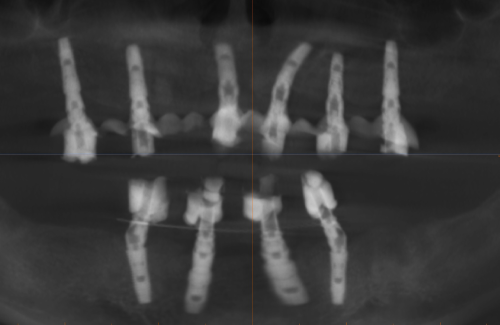 Удалены зубы, установлены 6 имплантатов на верхней и 4 на нижней челюсти