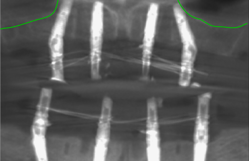 Рентгеновский снимок после операции операции
